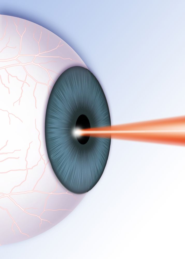 laser eye therapy