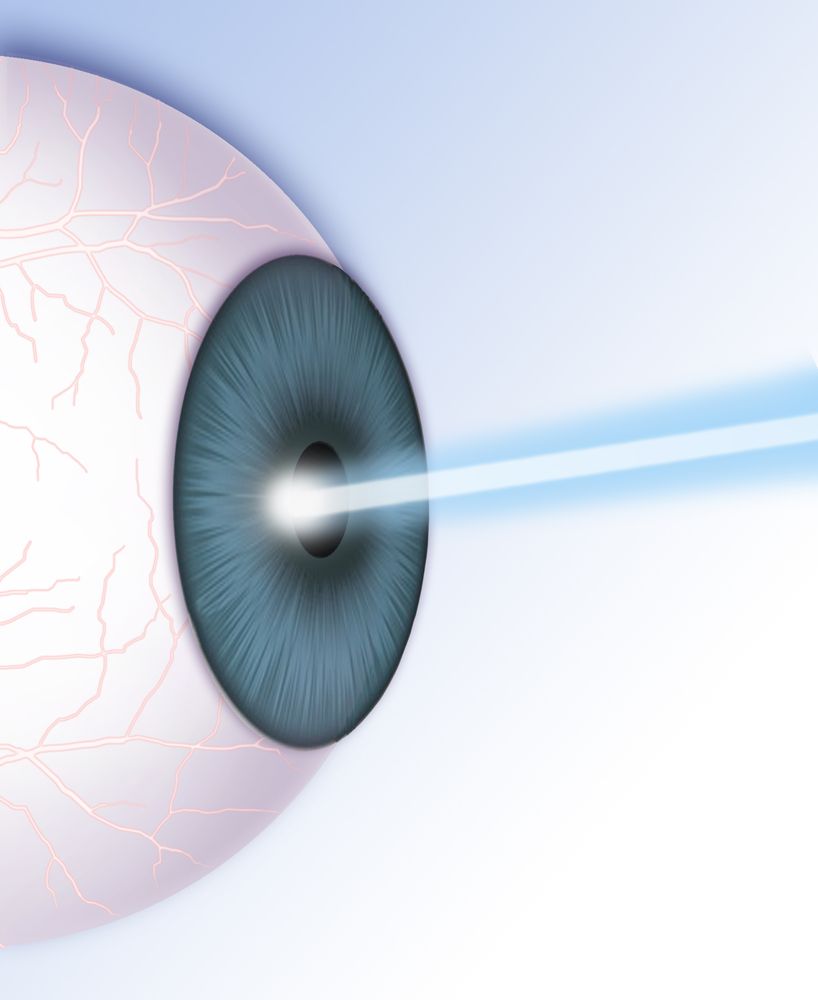 eye laser