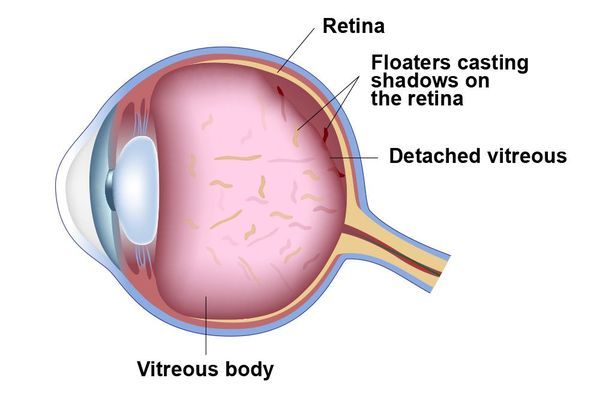 Eye Floater & Flashes