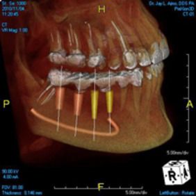 3d scan dental technology