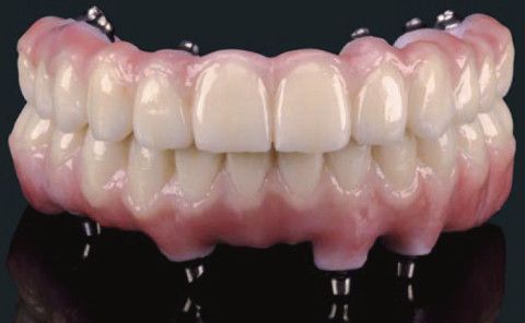 anatomy of a dental implant