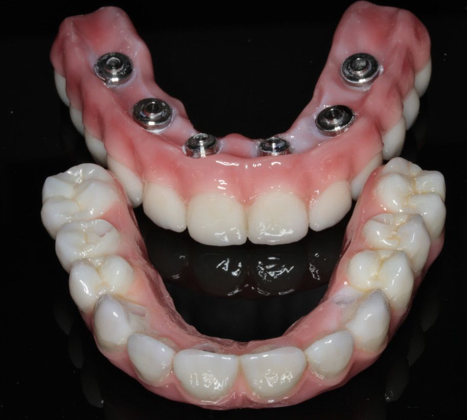 dental implants top view