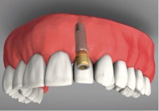 gum disease