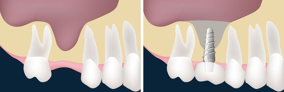 sinus lift