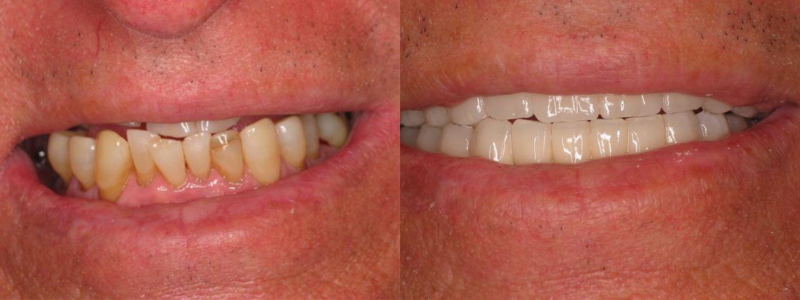 tooth loss jaw problem