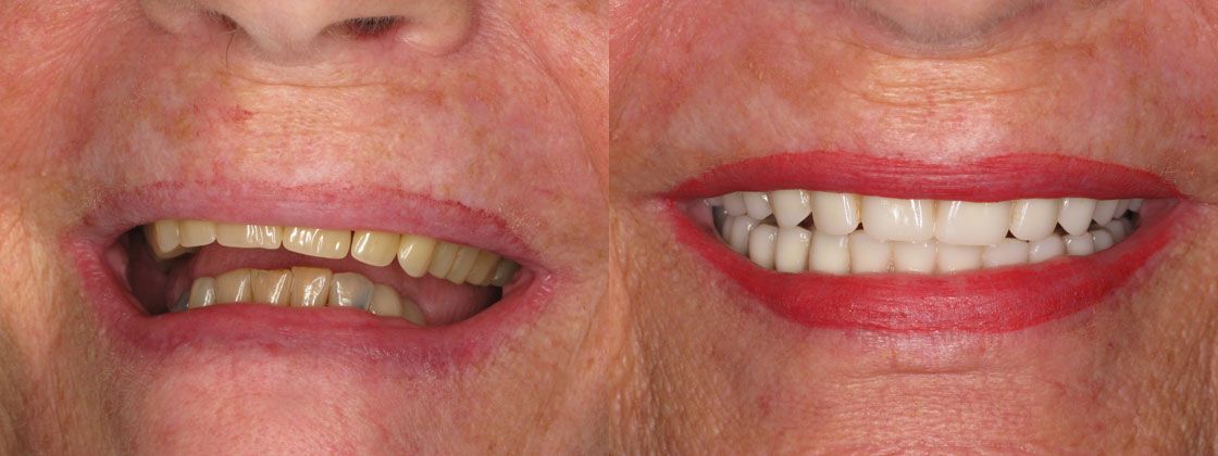 loose dentures solution