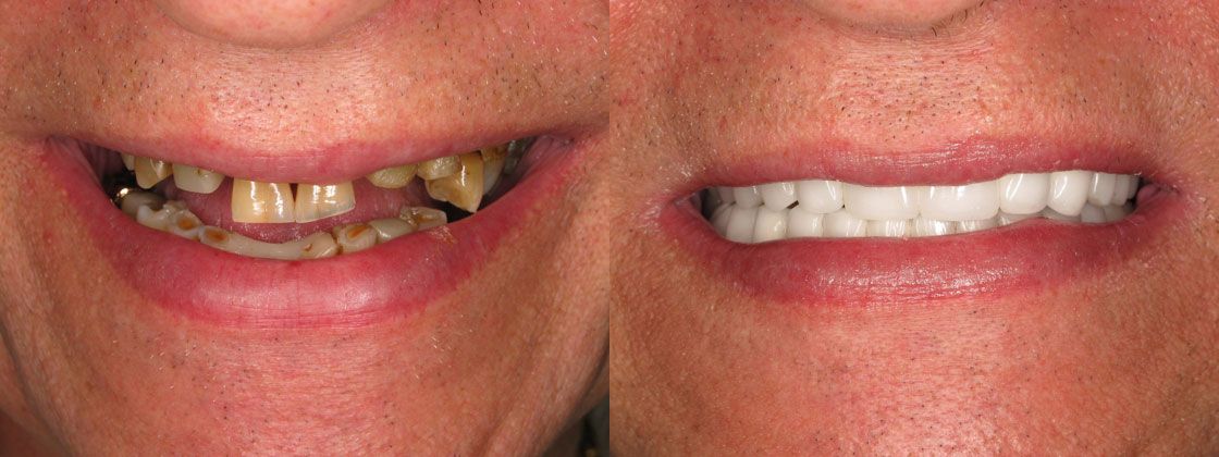 fixed missing teeth