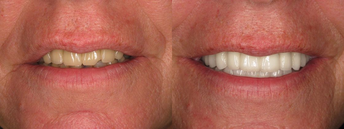 lost teeth solution porcelain