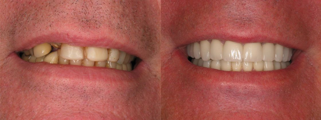 loose teeth problem fix