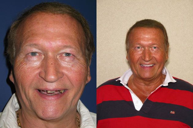 missing teeth man