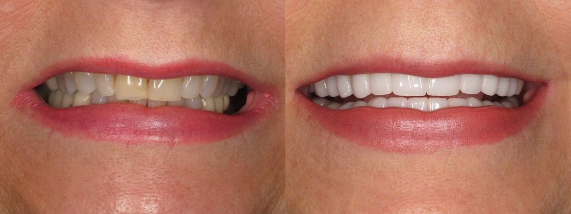 fix teeth color solution
