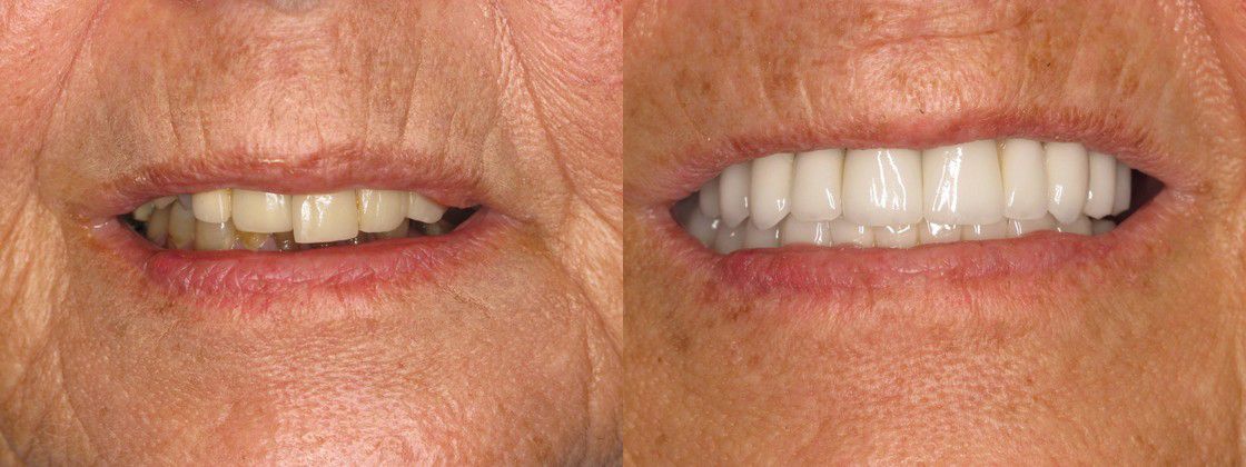 teeth bone loss after