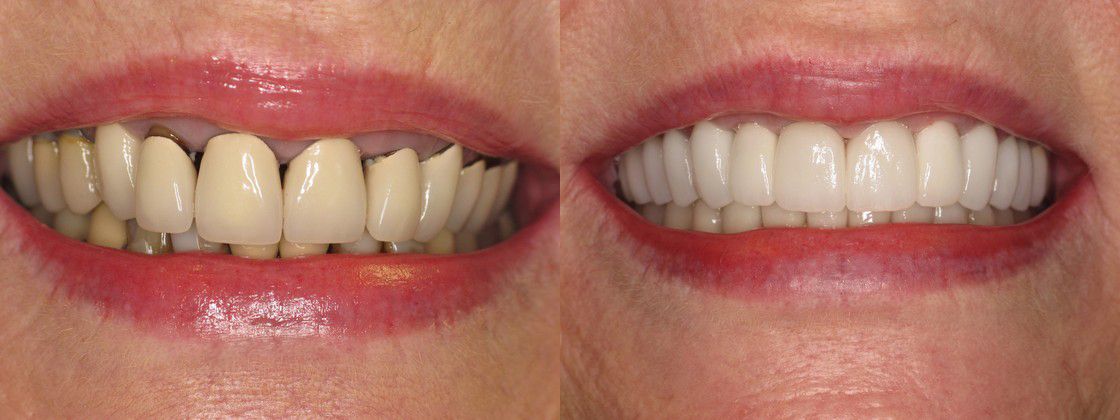 tooth decay periodontal fix