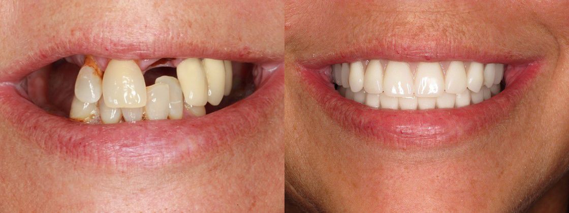 chipped cracked teeth solution