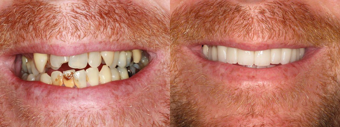 fix for tooth decay stained
