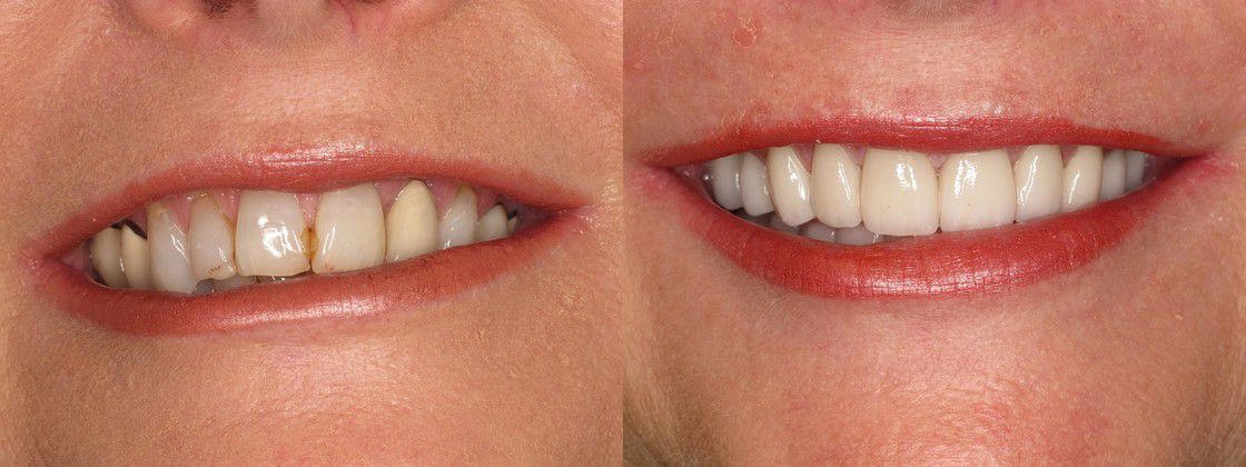 teeth overbite solution fix