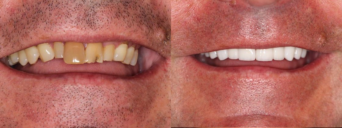 cracked teeth solution