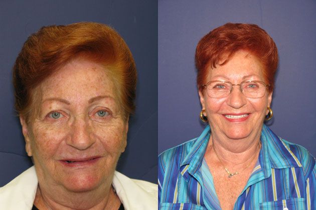 loose dentures