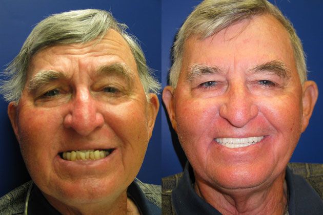 uneven teeth jaw drop
