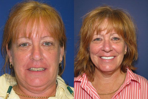 lost teeth elderly