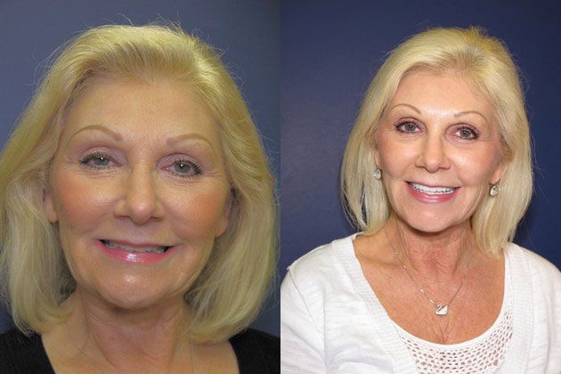 teeth discoloration