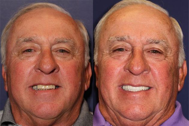 teeth bridgework problem