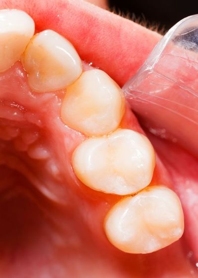 natural colored tooth filling