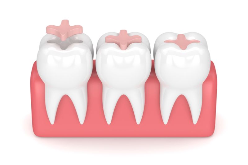 dental sealants cosmetic dentist palm beach