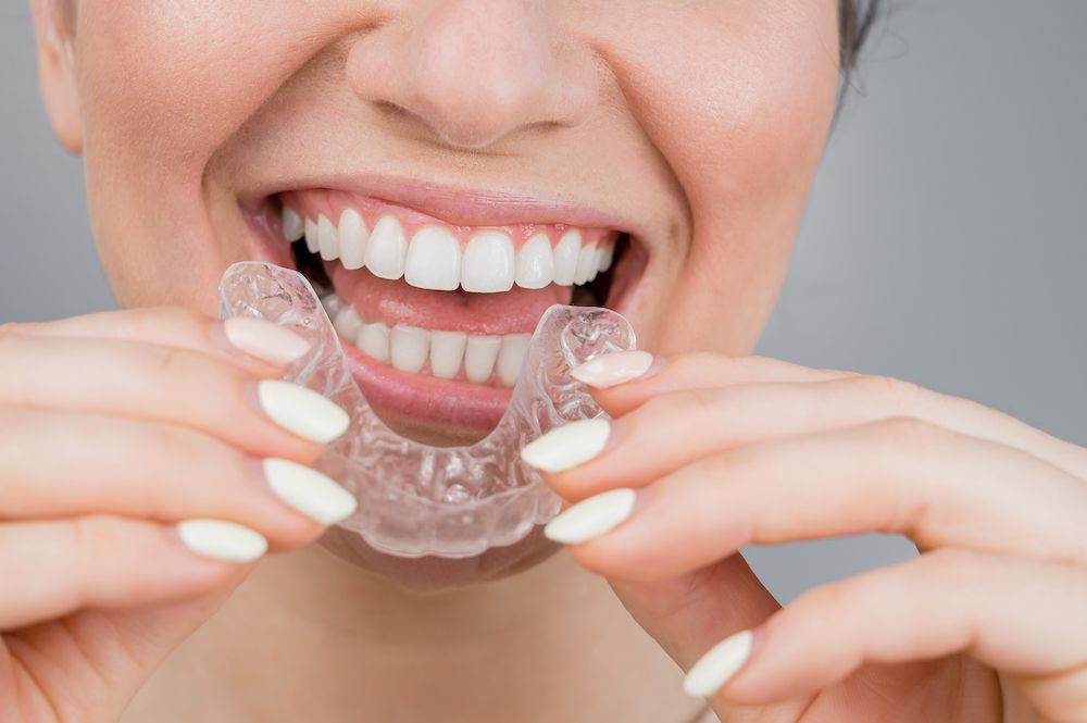 Do You Need to Wear a Retainer After Using Invisalign?