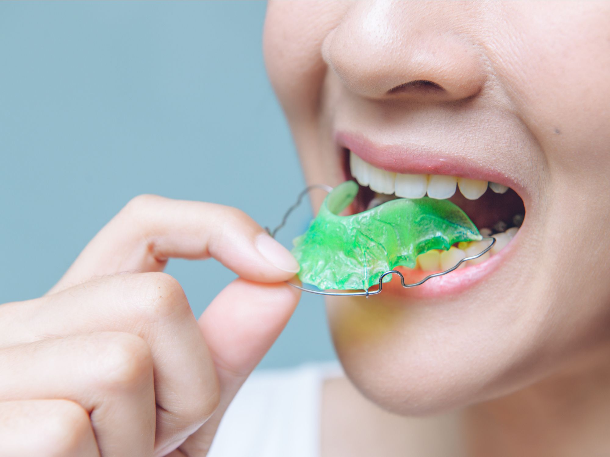 Should You Wear a Retainer After Braces?