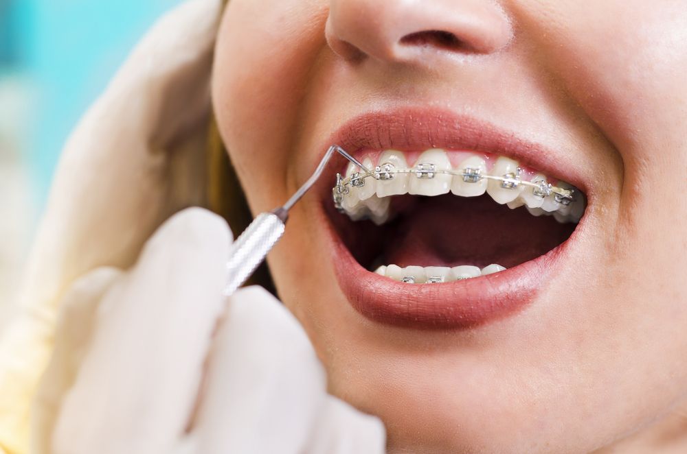 How to Brush Your Teeth and Floss When Wearing Braces