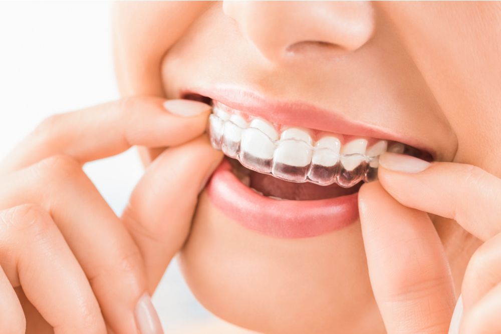Invisalign Tips and Tricks for Surviving Your First Week