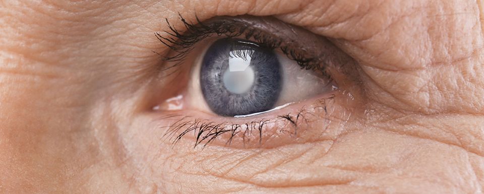 Are You At Risk for Cataracts?