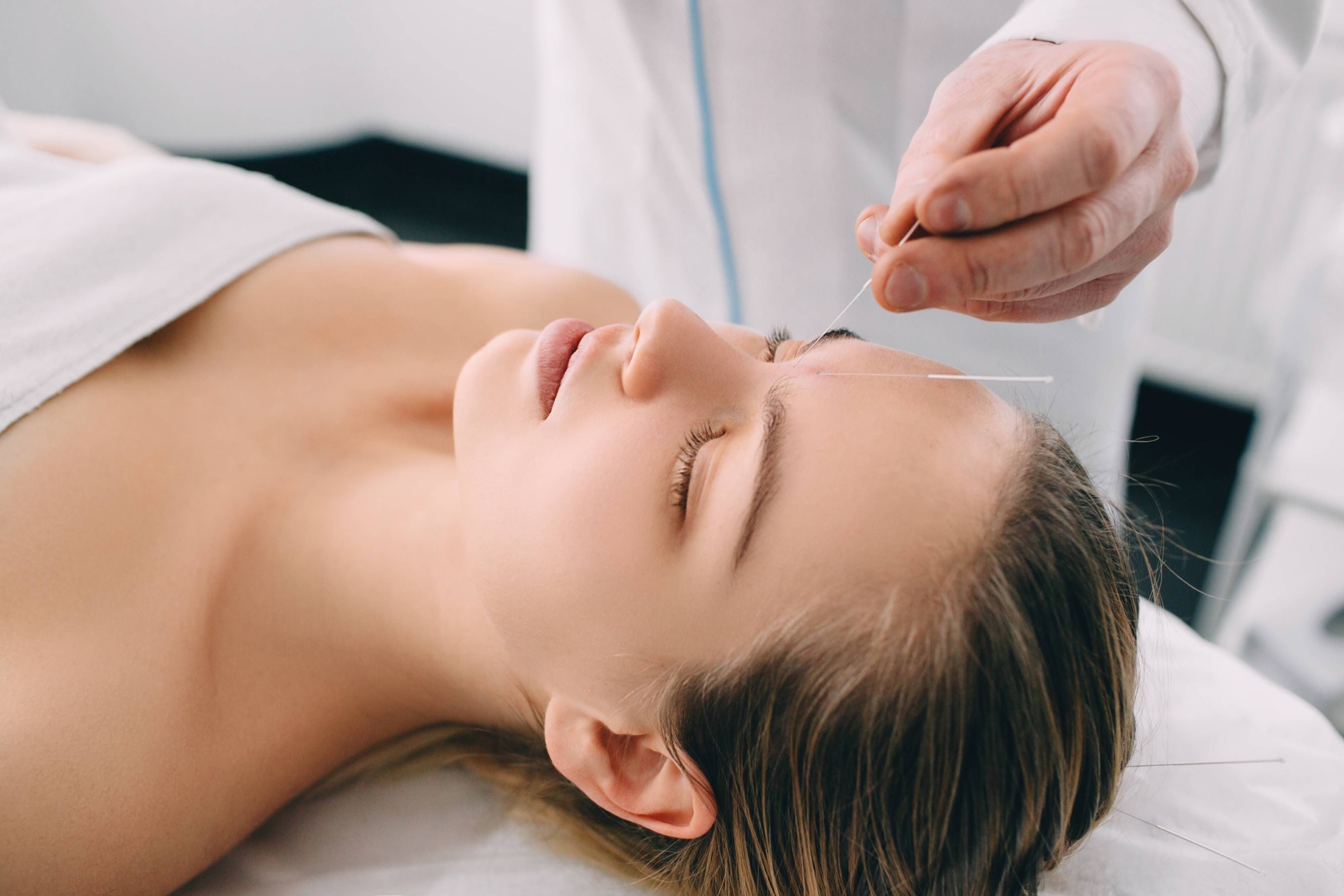 Top Benefits of Acupuncture