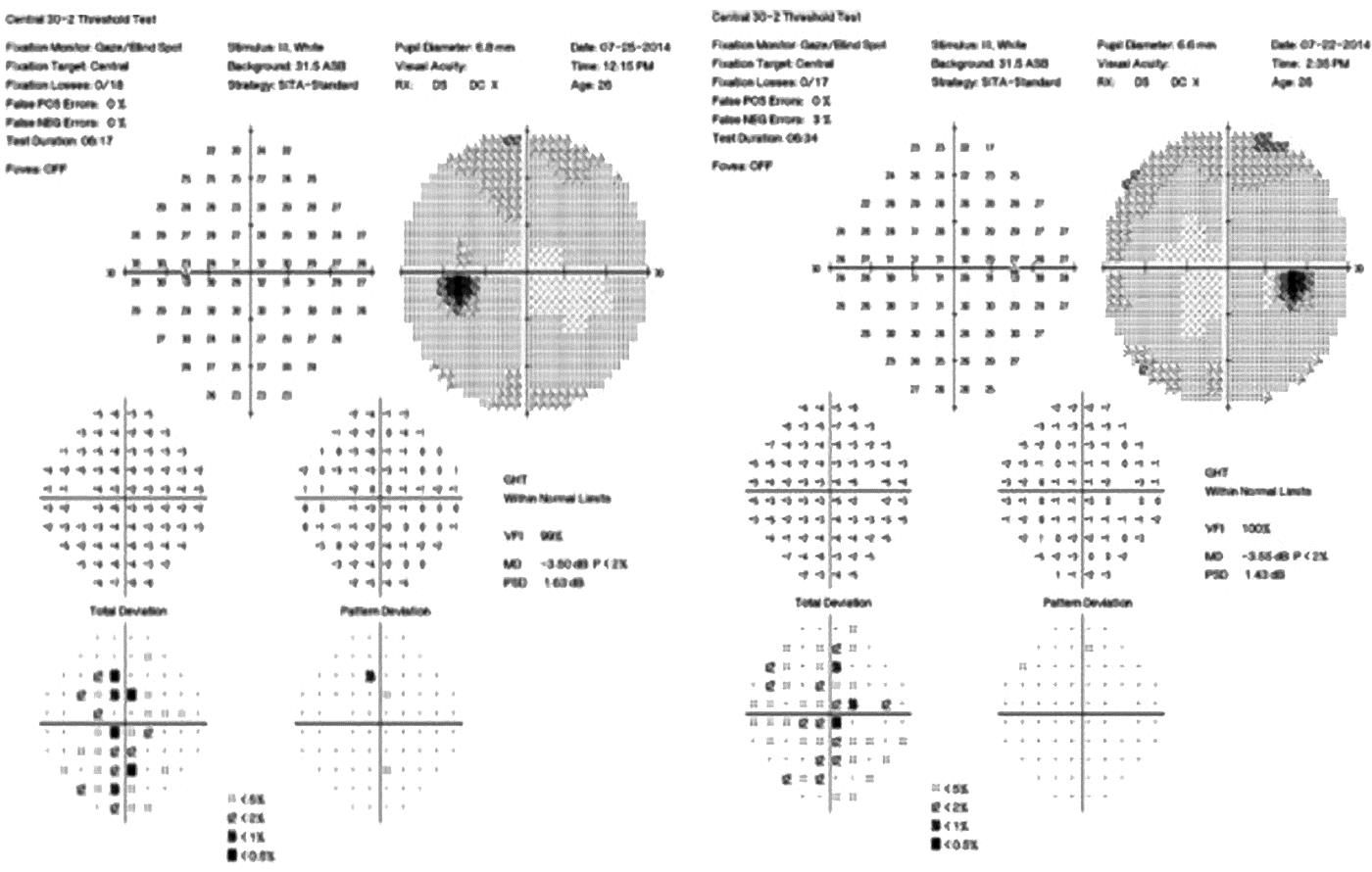 Humphrey Visual Field Analyzer