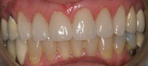 before dental procedure