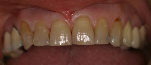 after dental procedure