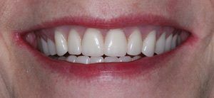 after dental procedure