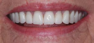 before dental procedure