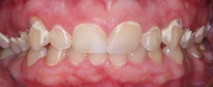 Dental Crowns