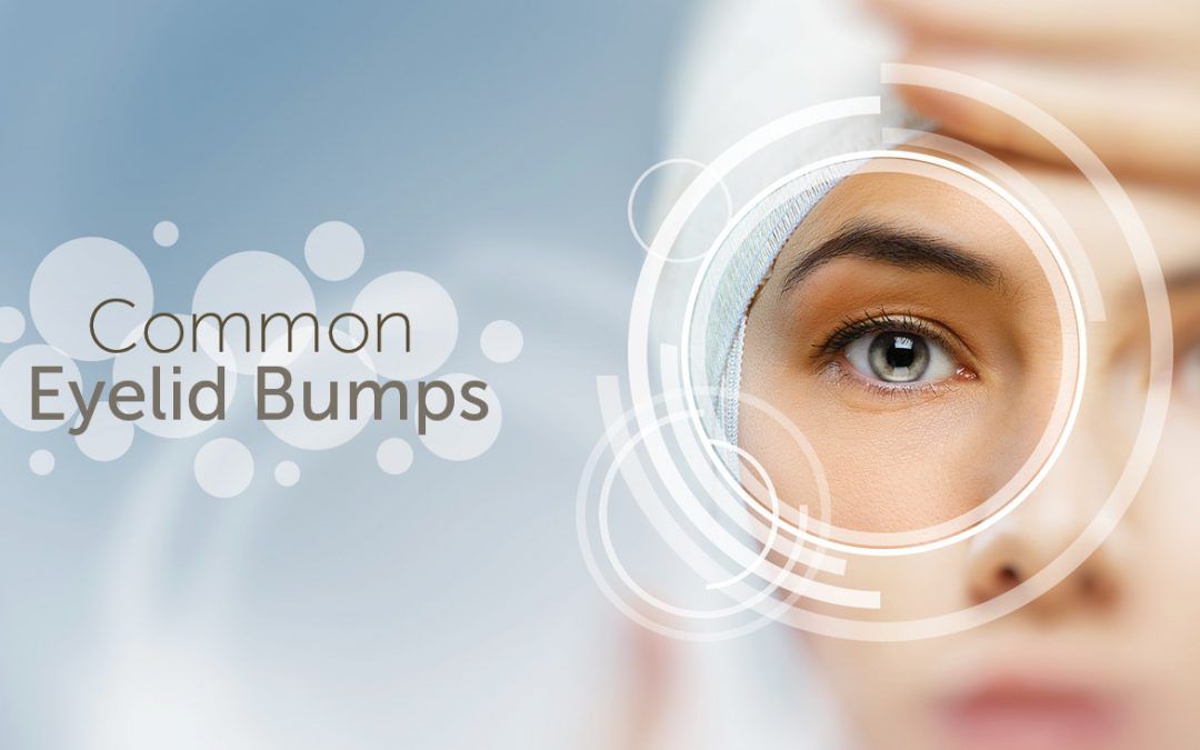 Common Eyelid Bumps