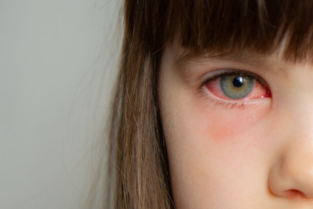 My Child Has Pink Eye. Now What?