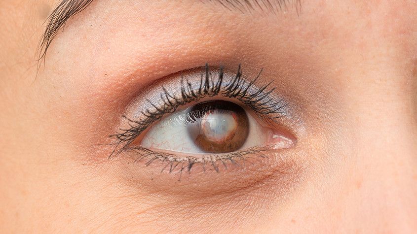 Cataract and Glaucoma