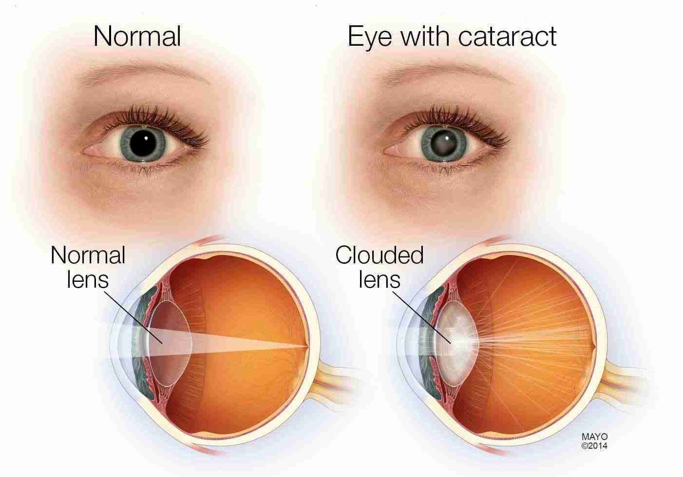 Cataract care in Las Vegas, 