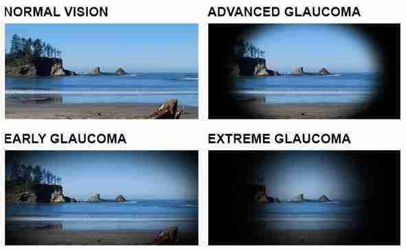 Glaucoma care in Las Vegas, 