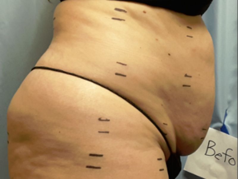 Before laser lipo