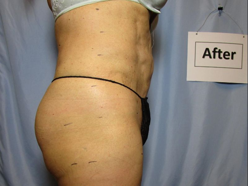 Before and After Laser Liposuction