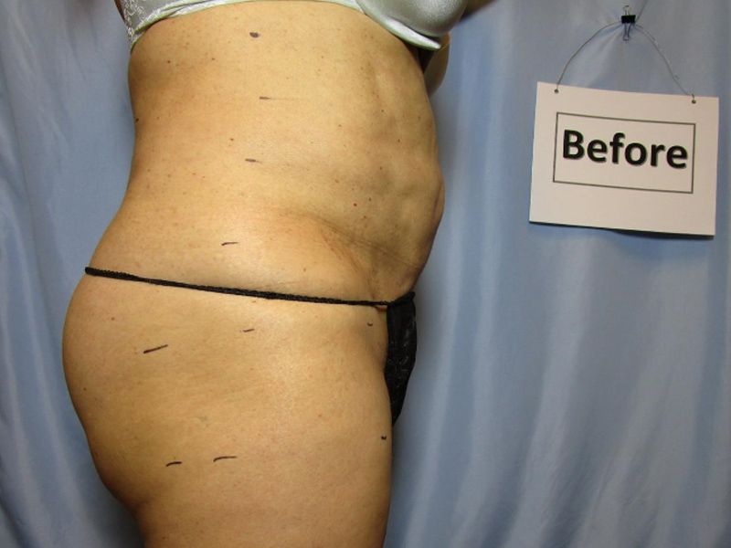 Before and After Laser Liposuction