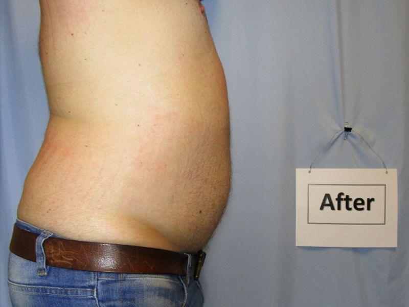 After Liposuction