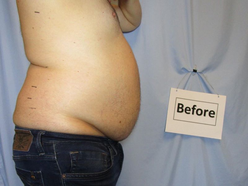 Before Liposuction